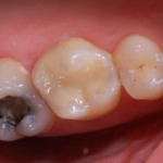 White tooth fillings