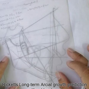 Ricketts long-term arcial growth prediction without treatment in Orthodontics