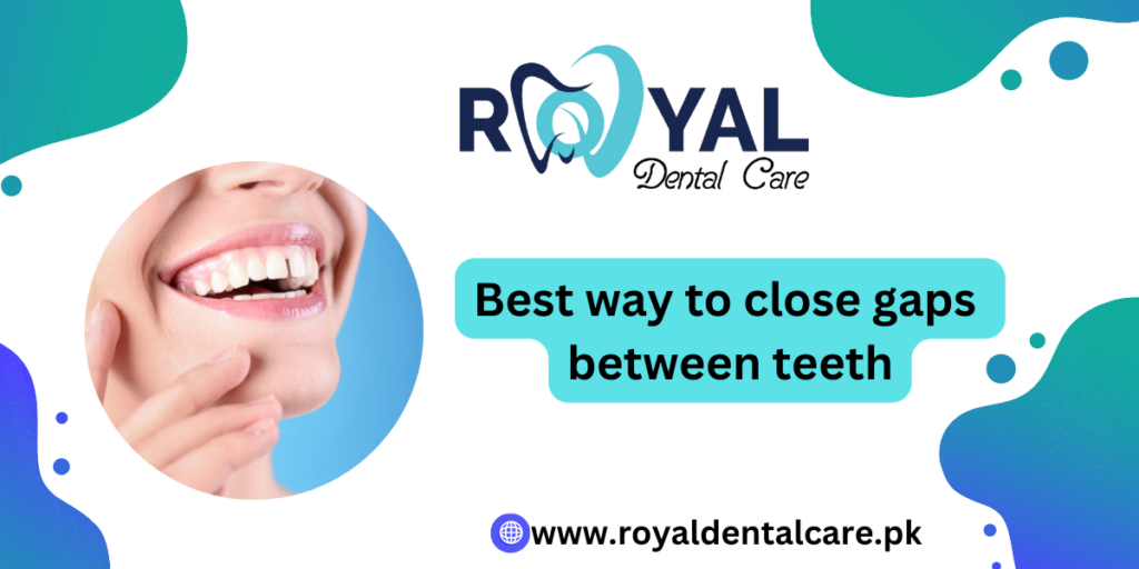 Best way to close gaps between teeth