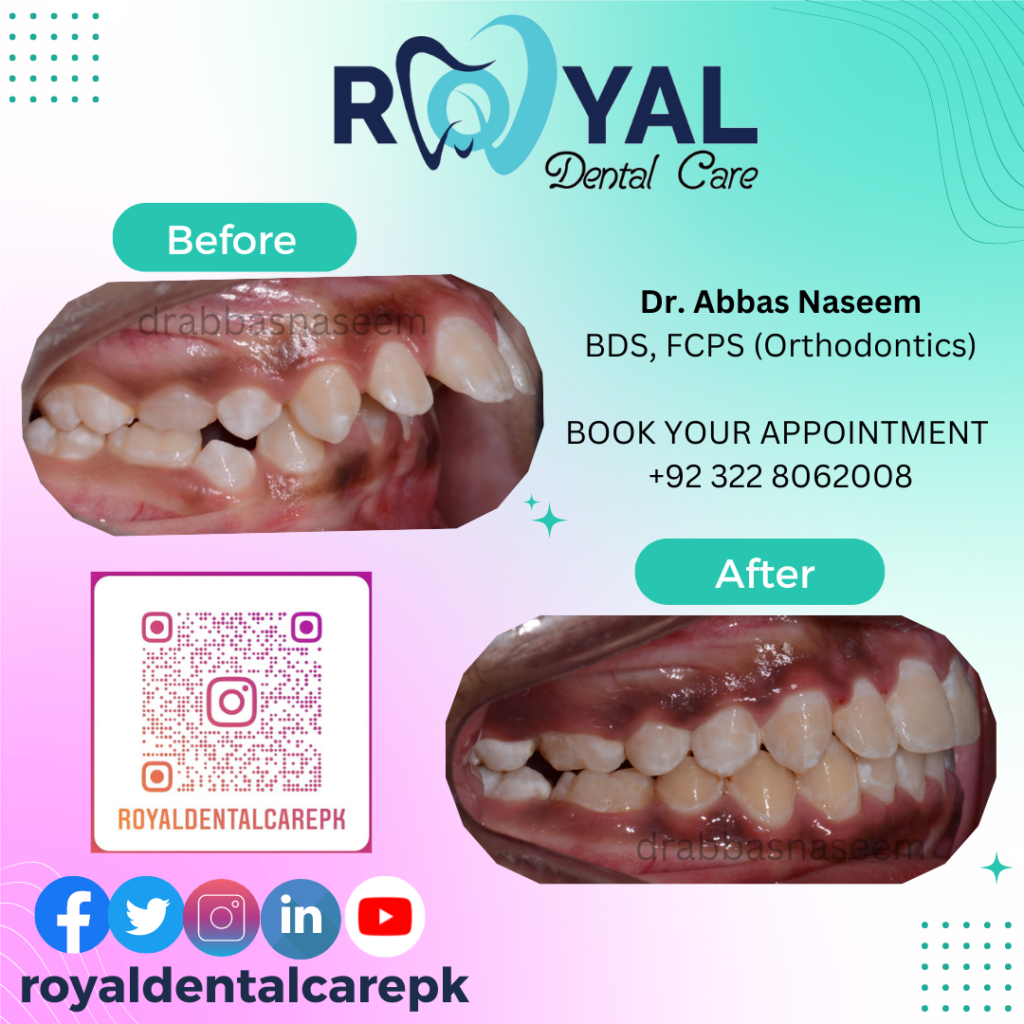 growth modification orthodontic treatment Dr Abbas Consultant Orthodontist