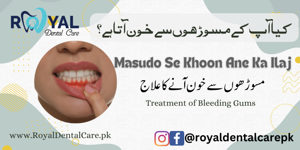 treatment of bleeding gums (Masudo Se Khoon Ane Ka Ilaj, مسوڑھوں سے خون آنے کا علاج)?
