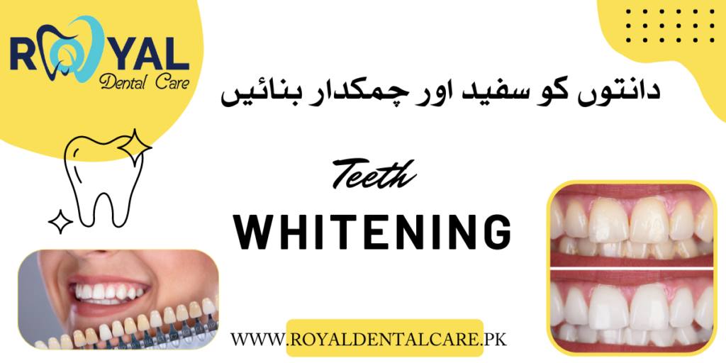 Teeth whitening or bleaching (دانتوں کو سفید اور چمکدار بنائیں,ٹیتھ بلیچنگ ، ٹیتھ وائٹننگ )