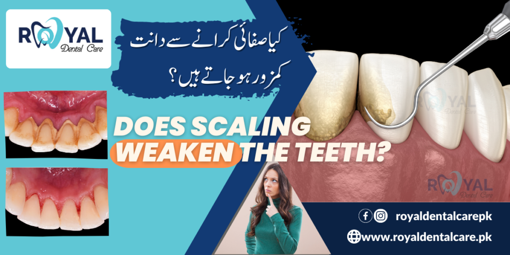 Does scaling weaken the teeth?